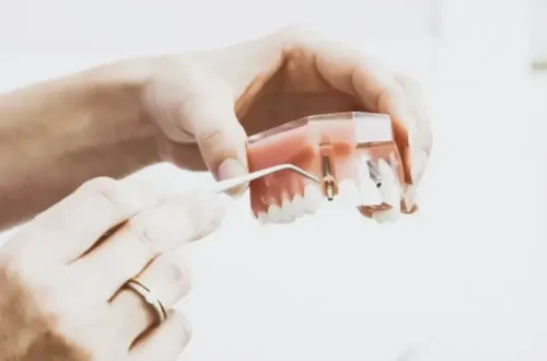 What Is the Real Process for Getting a Dental Implant in Indianapolis?